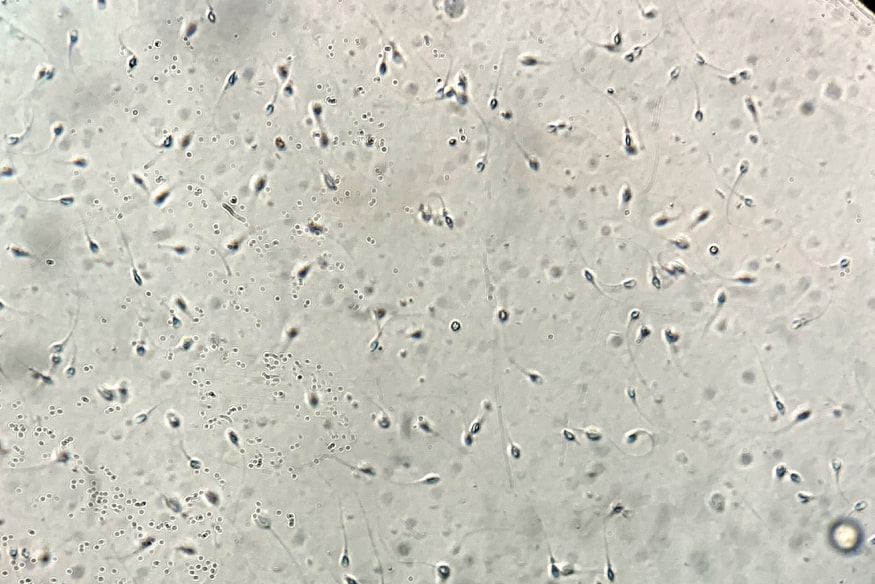 leukocytospermia